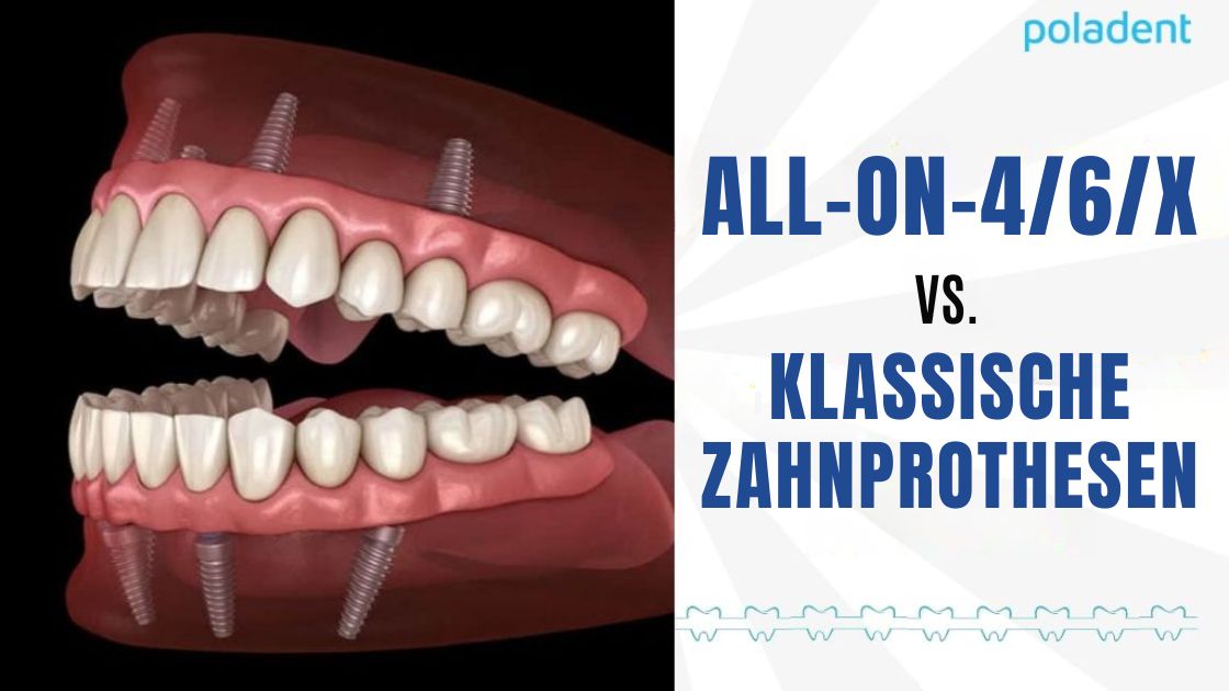 All-on-4/6/x vs. klassische Prothesen