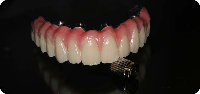 Dental Implants