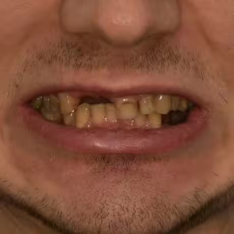 Before Treatment