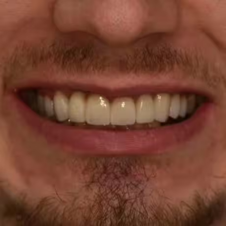 After Treatment