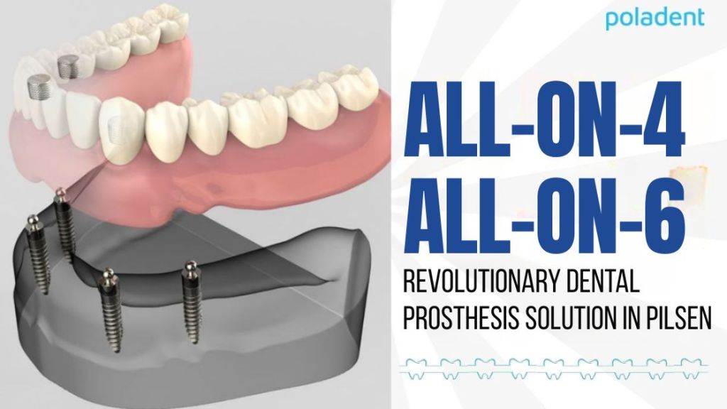 All-on-4® and All-on-6®: Revolutionary dental restoration solutions