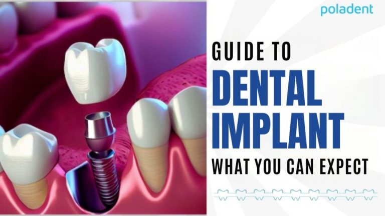Dental Implant Placement Guide: What to Expect Step by Step – [EN] Poladent