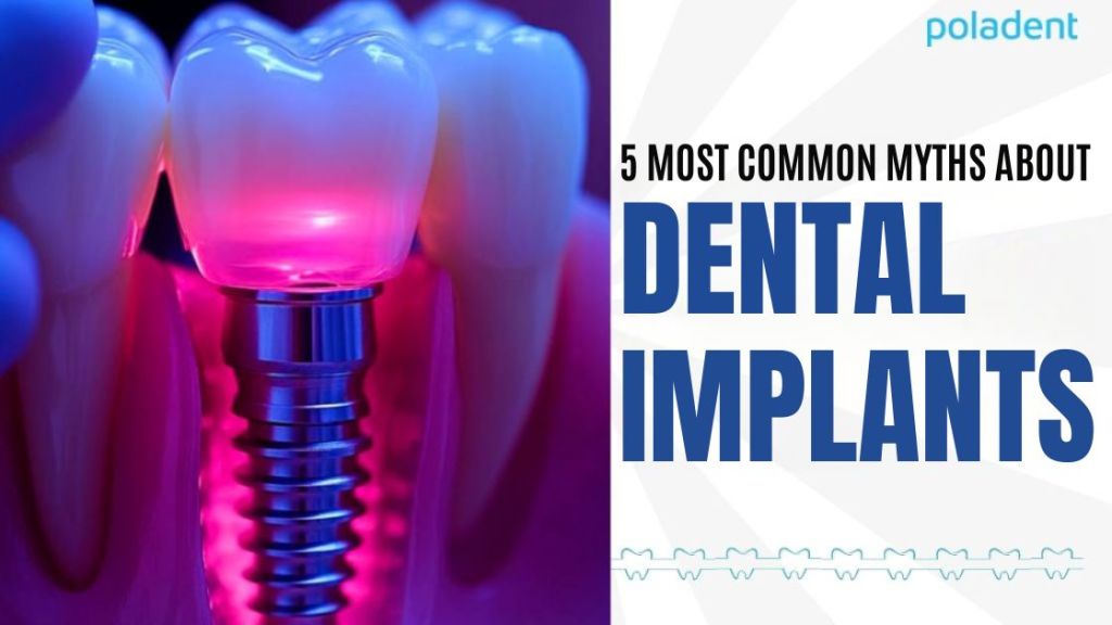 5 most common myths about dental implants