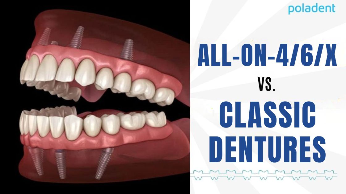 All-on-4/6/x vs. classic dentures