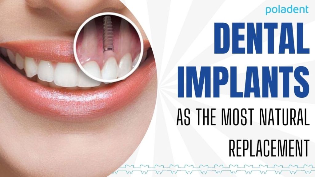 Dental implant as the most natural replacement