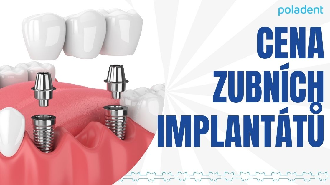 Cena zubních implantátů