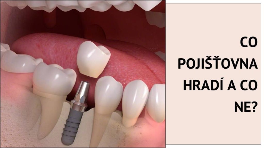 Co pojišťovna hradí a co ne