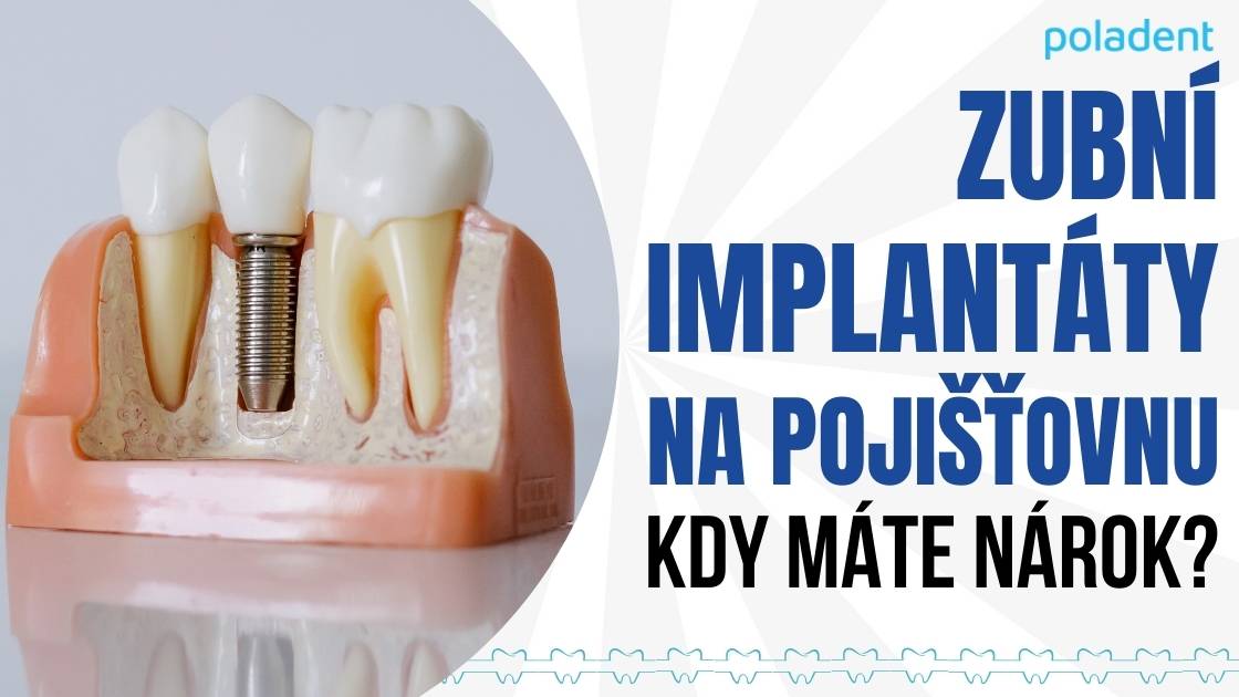 Zubní implantáty na pojišťovnu: Kdy máte nárok?